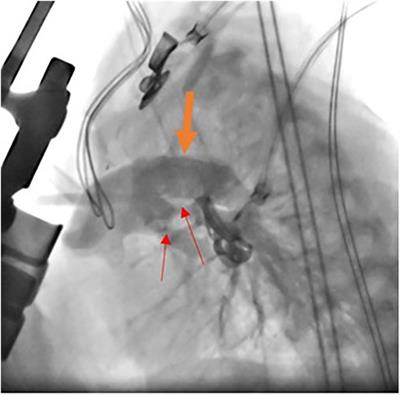 Hybrid stage 1 palliation for HLHS: the experience of a tertiary center in a developing country